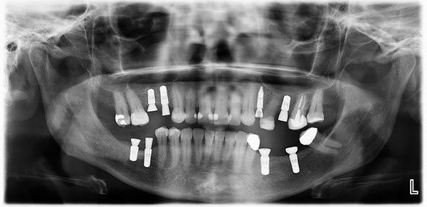 Dental Implant