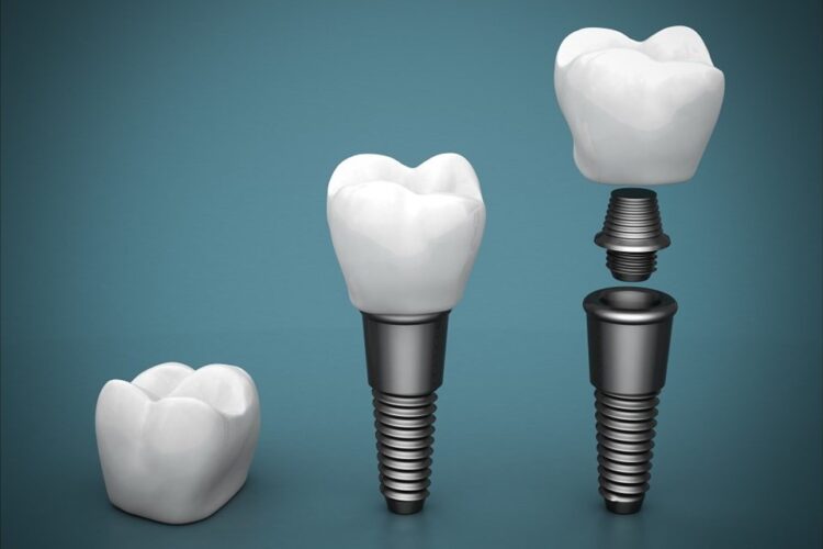 Lifespan Of Dental Implants