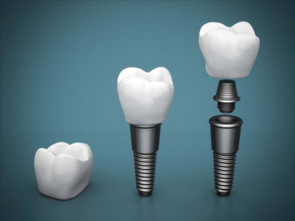 Lifespan Of Dental Implants