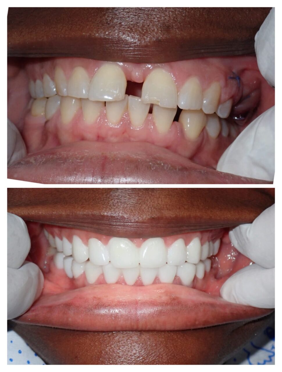 Smile Makeover