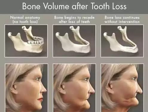 Bone after Tooth Loss