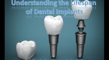 Understanding The Lifespan Of Dental Implants