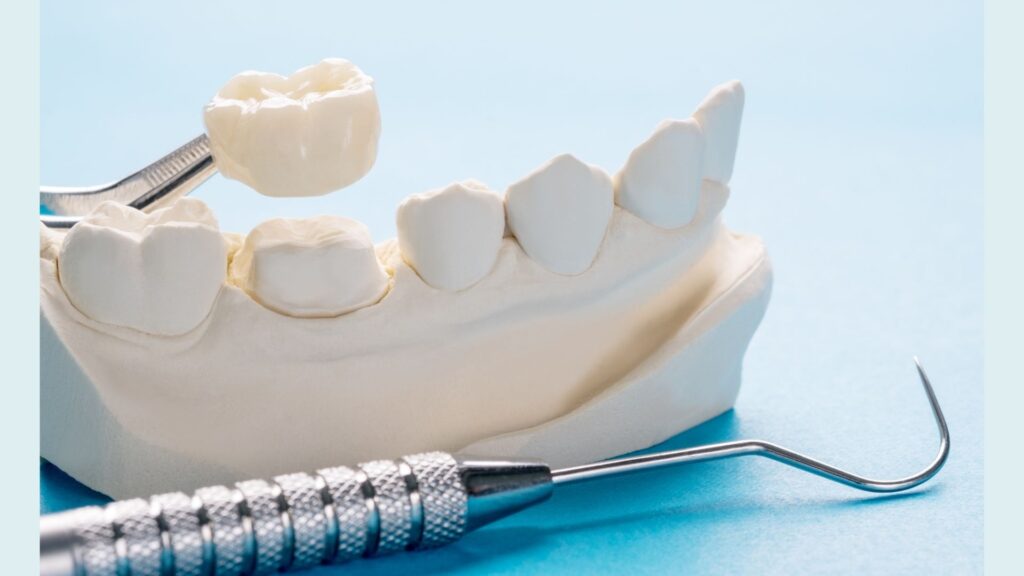 All Ceramic Crowns And Bridges