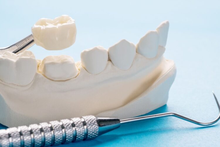 All Ceramic Crowns And Bridges