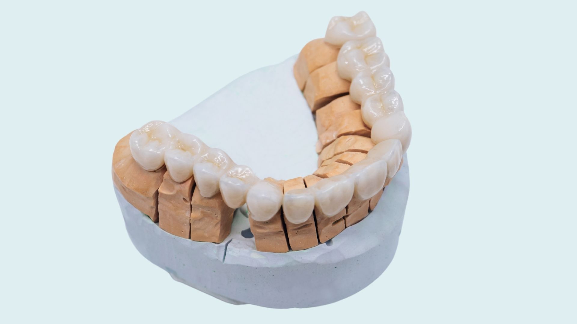 Dental Crown And Bridges In East Delhi