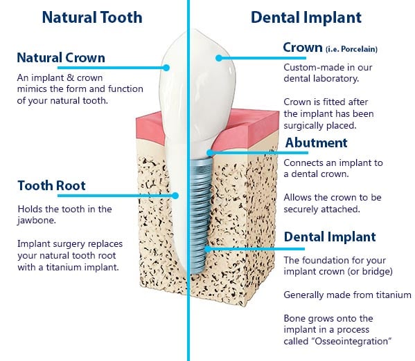 Dental Implants