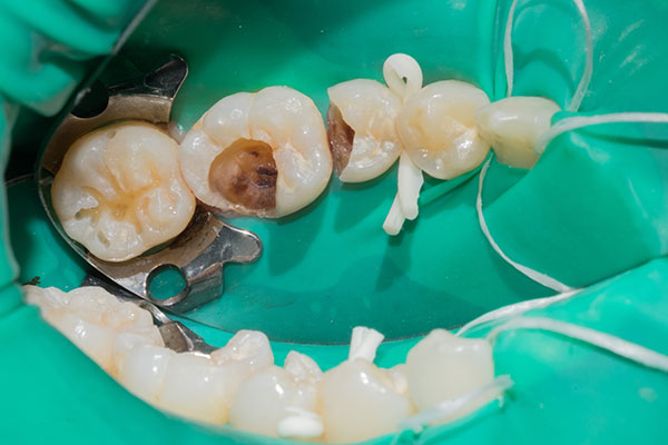 Endodontics