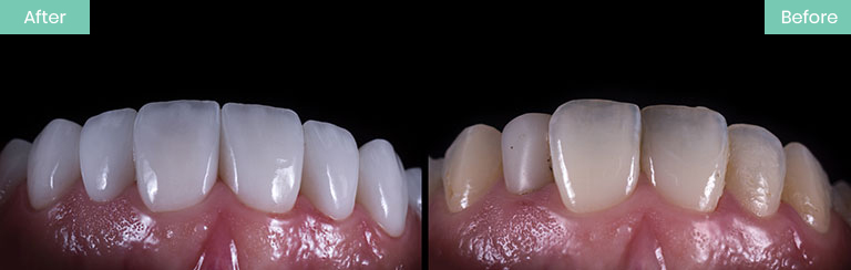 Porcelain Veneers Procedure