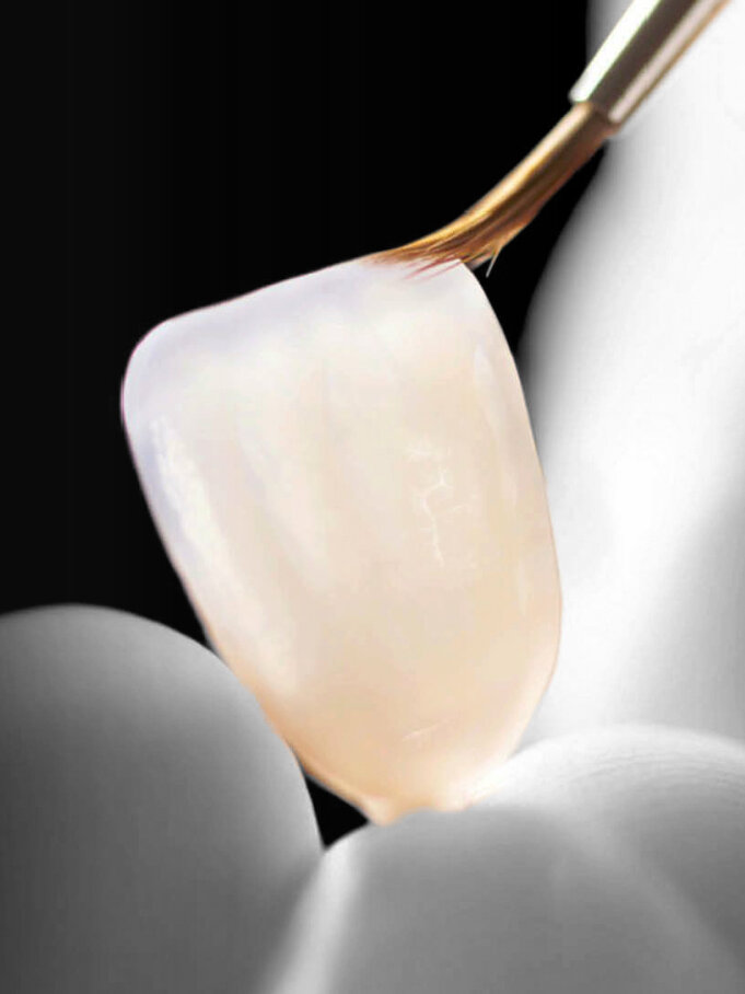 Porcelain Veneers