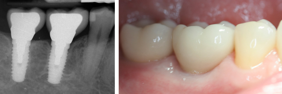 Single Tooth Dental Implant
