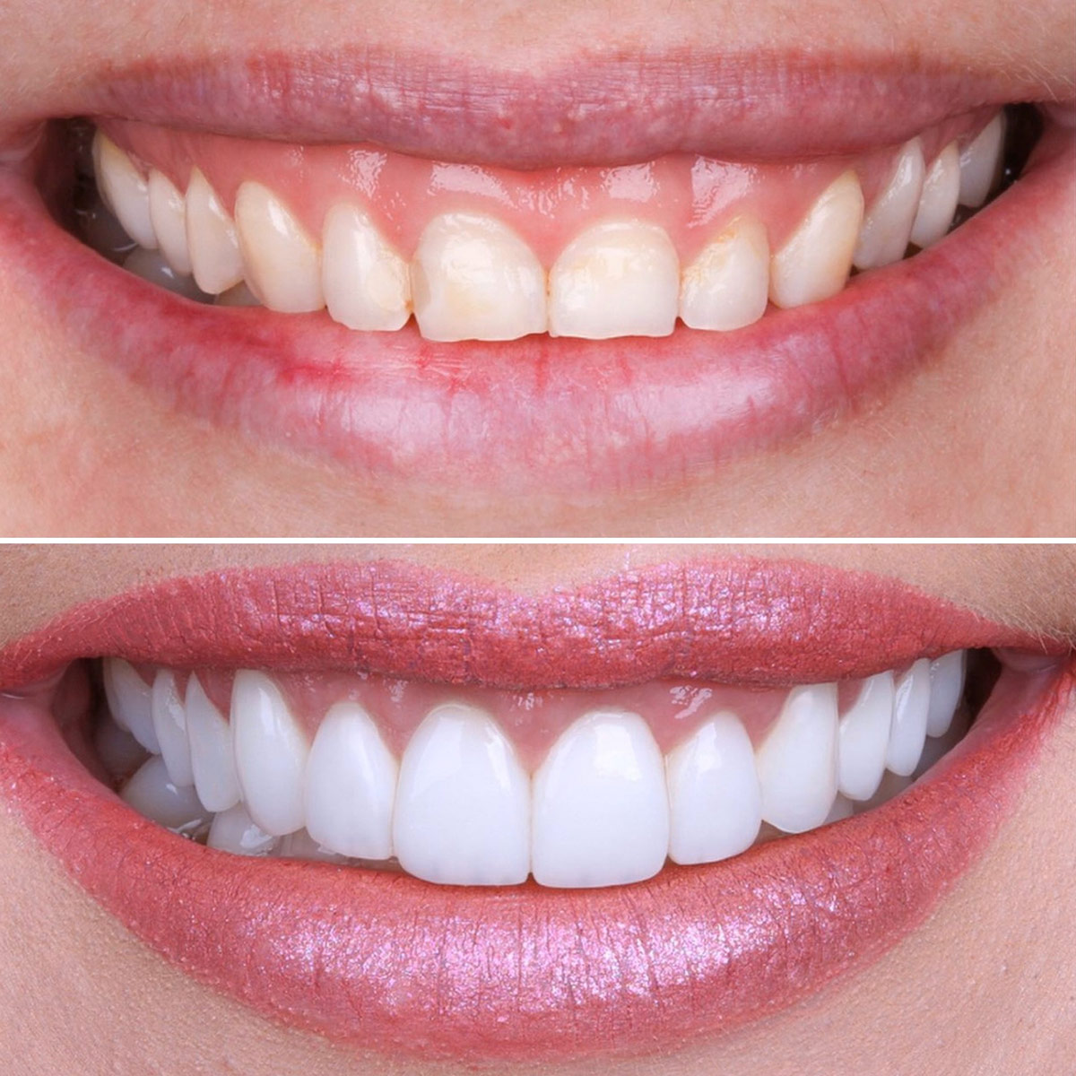 Smile Makeover With Porcelain Veneers