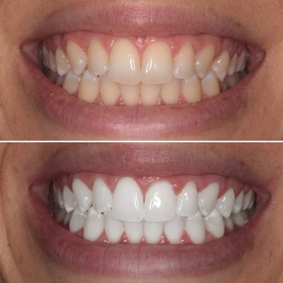Teeth Whitening In Delhi