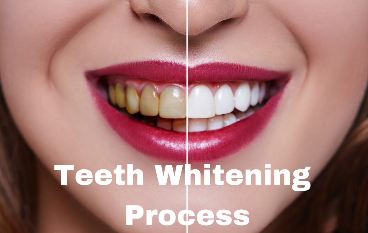 Teeth Whitening Process
