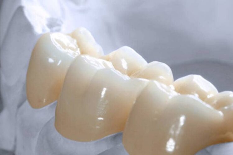 All Ceramic Crowns