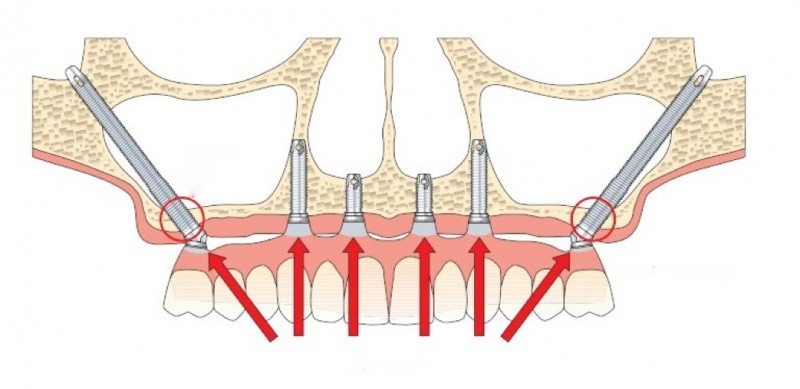 Esthetica Zygomatic Implants