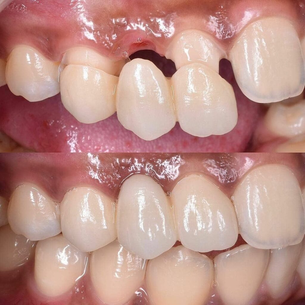 All Ceramic Bridge