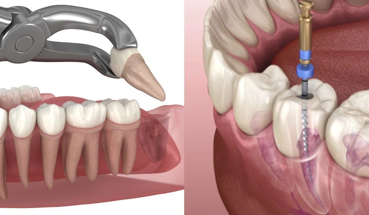 Benefits Of Choosing Root Canal
