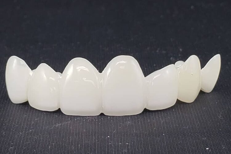 Can All-Ceramic Crowns and Bridges Prevent Tooth Loss