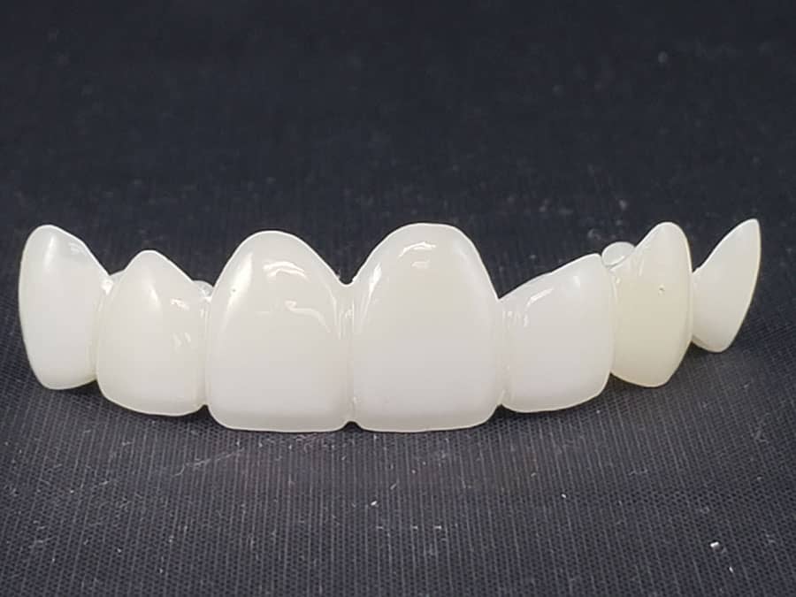 Can All-Ceramic Crowns and Bridges Prevent Tooth Loss