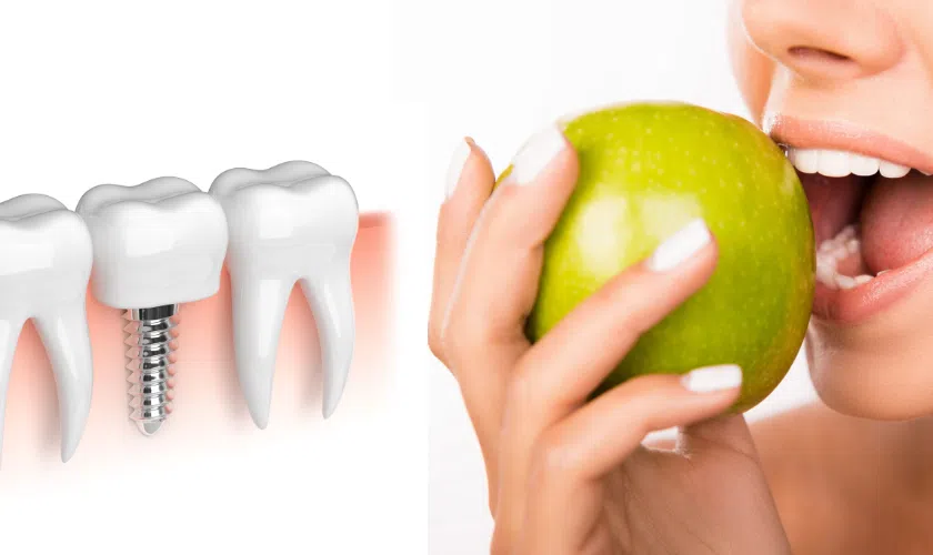 Chewing And Dental Implants