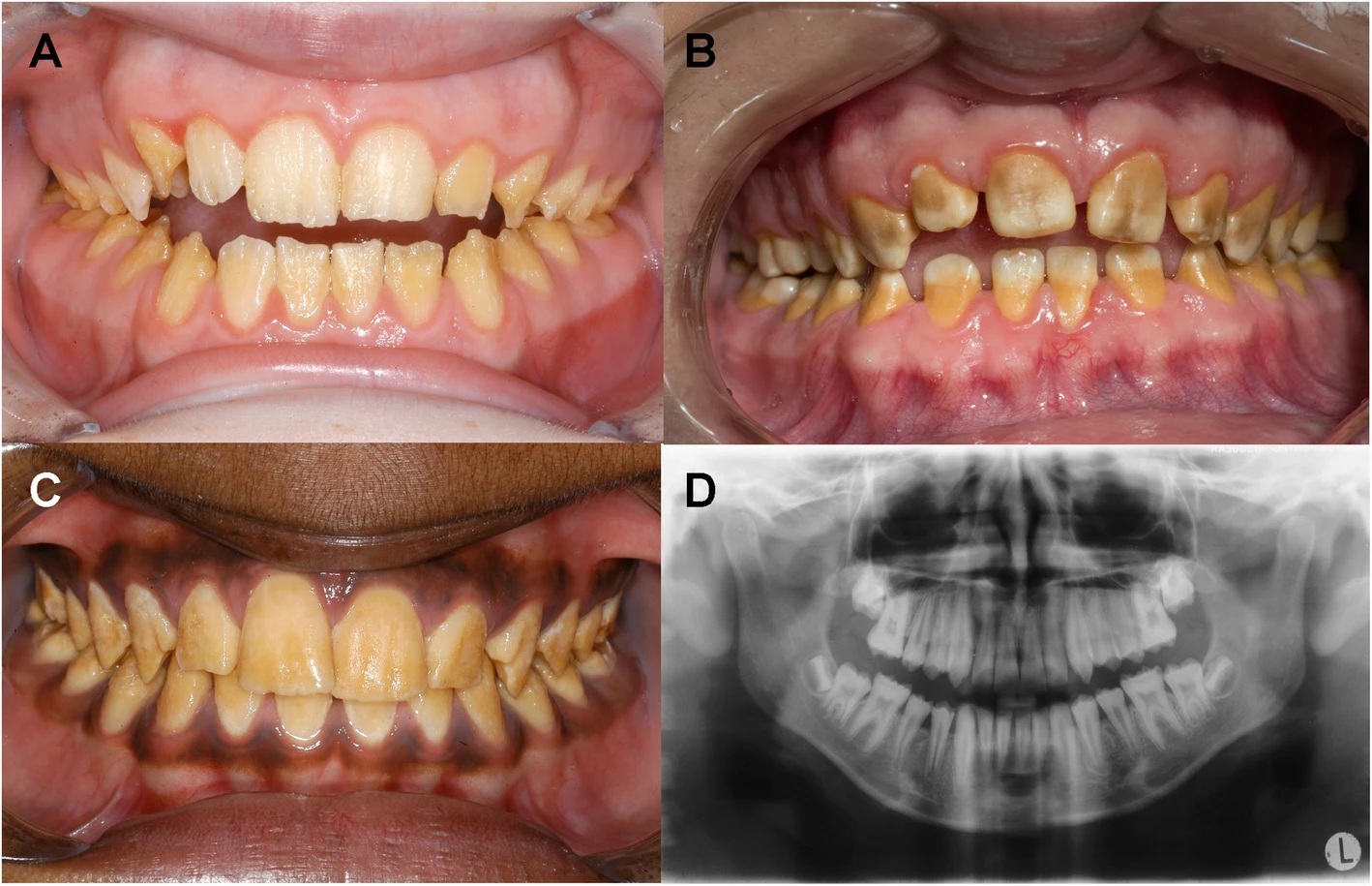 Enamel Formation