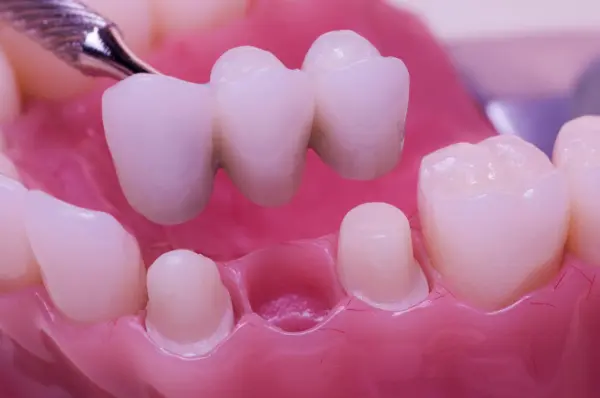 How Affordable Are All Ceramic Crowns And Bridges