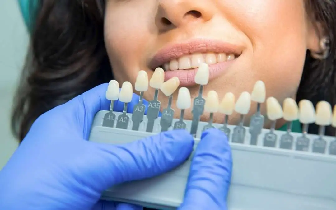 Preparing For Your Whitening Treatment