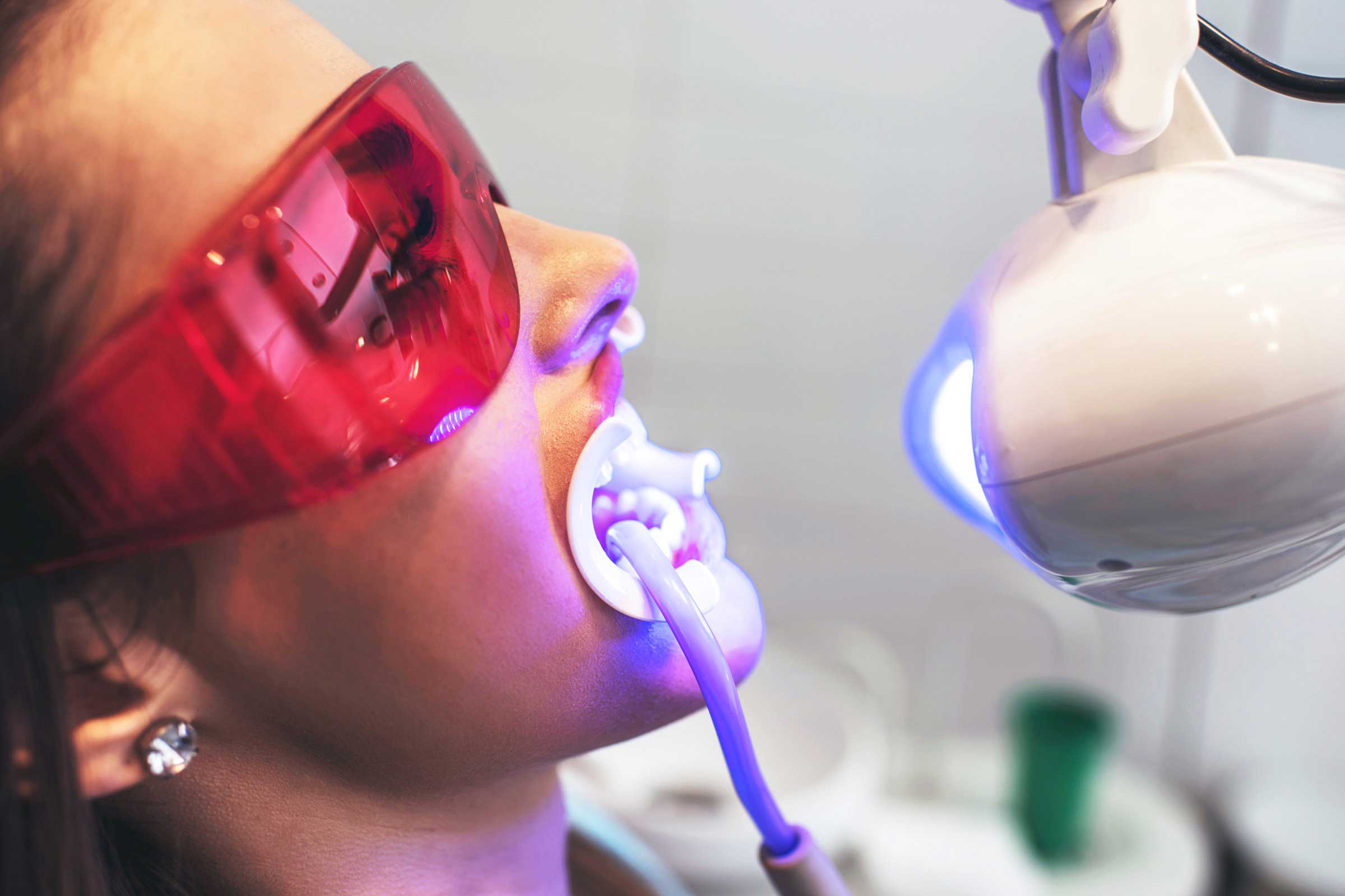 Teeth Whitening In Delhi
