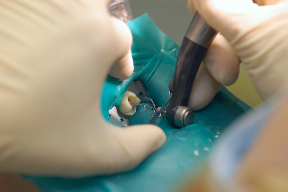 Undertsanding A Root Canal Treatment