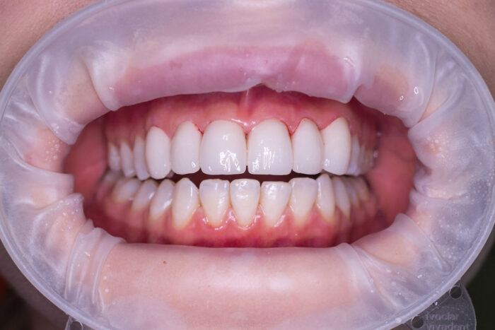 What Are All Ceramic Crowns