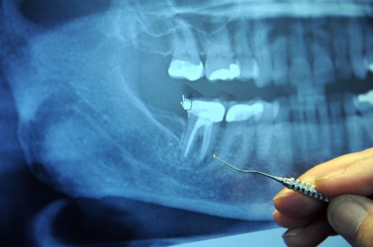 What To Expect During Pain Free Root Canal