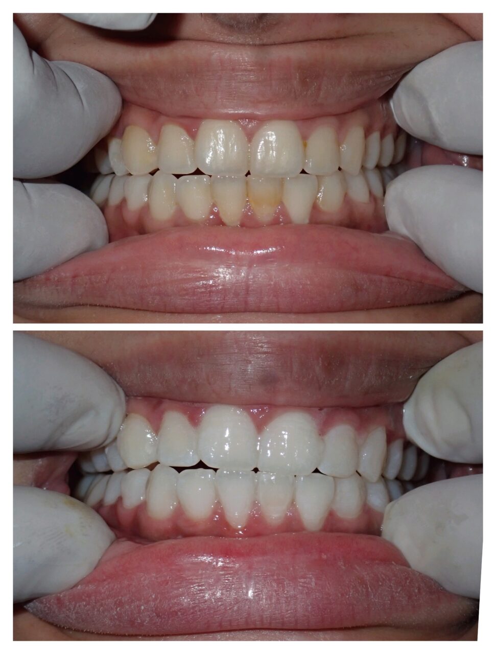 Why In-Clinic Whitening is Better for Your Brain (and Teeth)