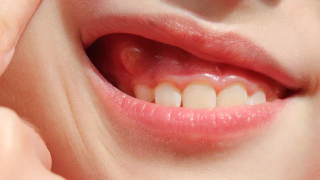 What Is A Gum Boil Types And Treatments Icard And Strein Family Dentistry