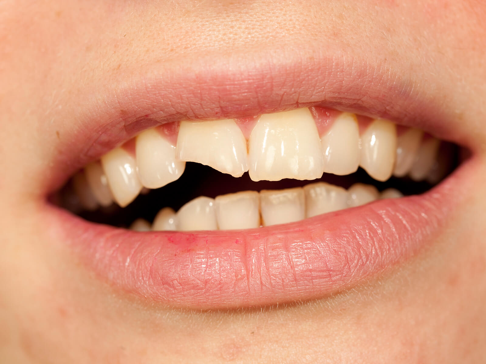 Cracked Or Chipped Tooth