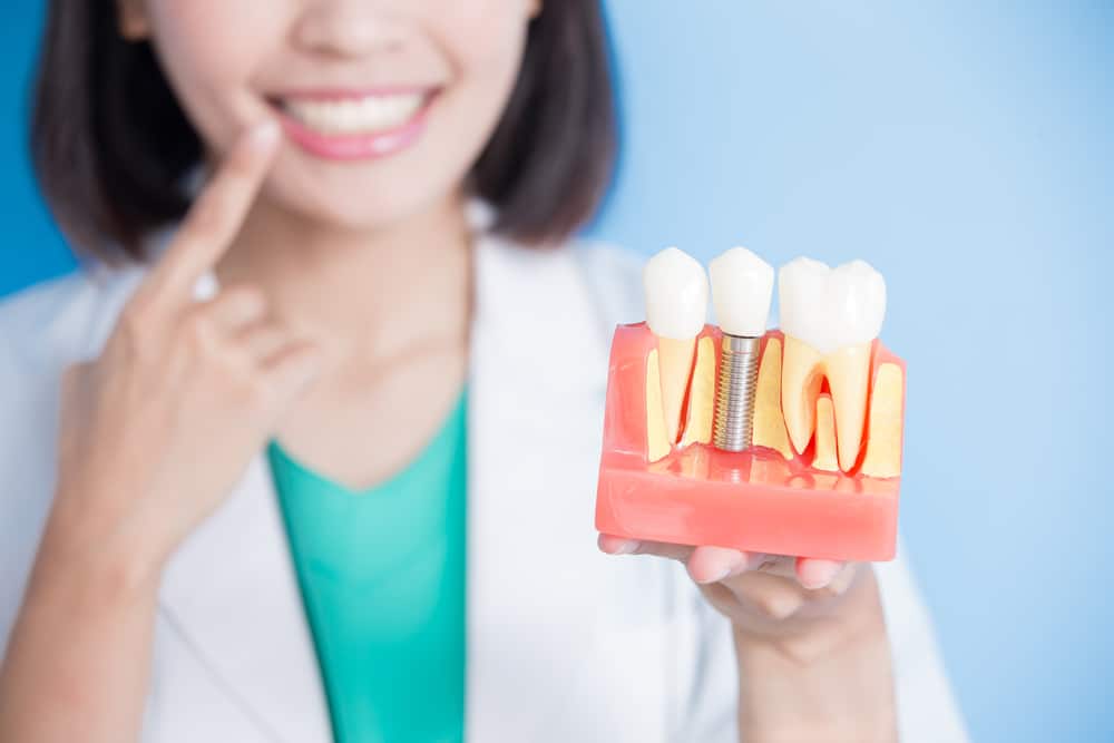 Dental Implants