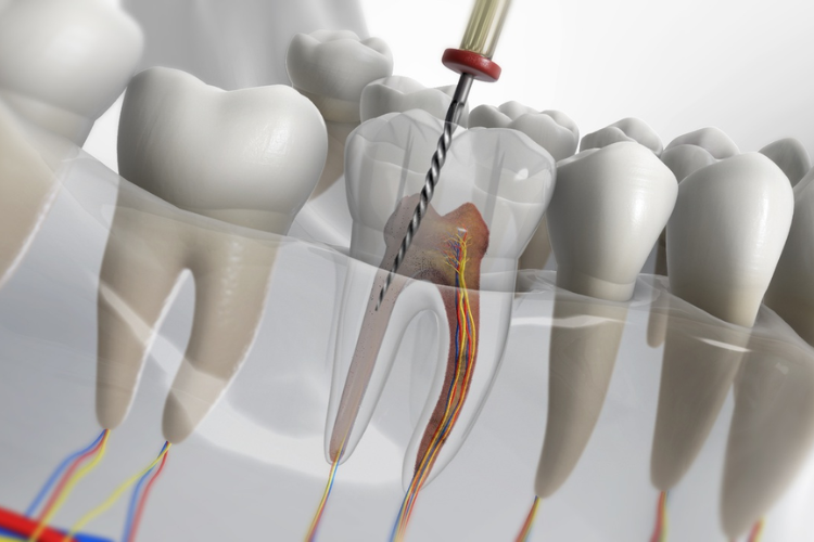 Silent Signs You May Need Root Canal