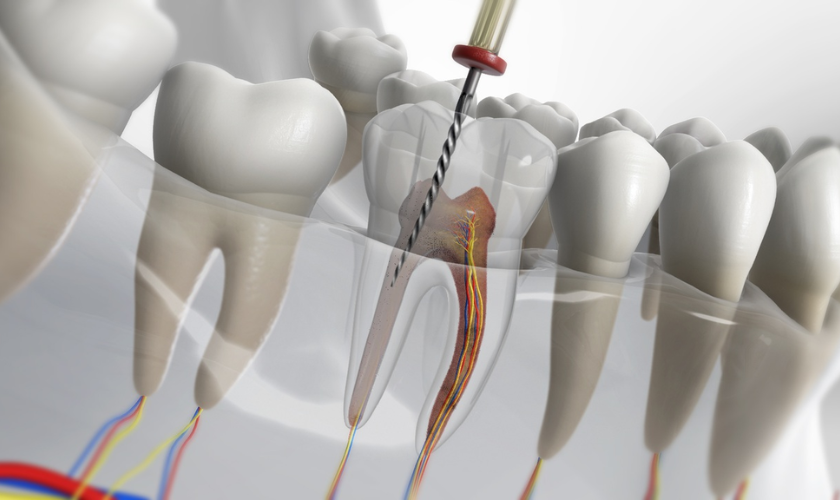 Silent Signs You May Need Root Canal