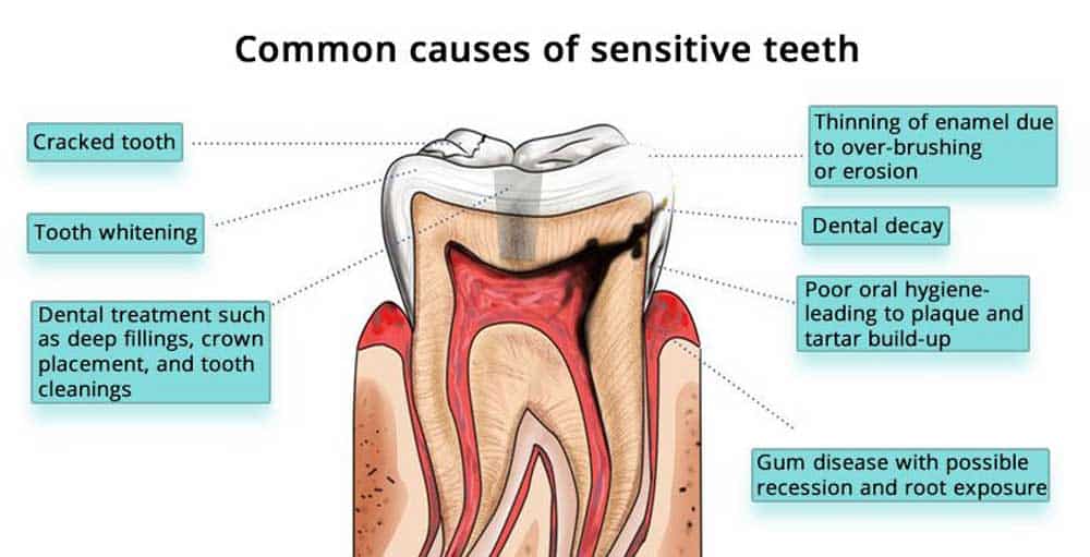 Understanding Tooth Sensitivity