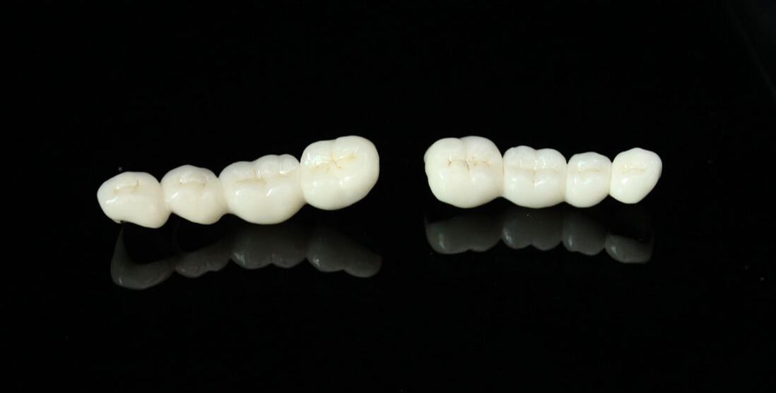 What Are Ceramic Dental Bridges