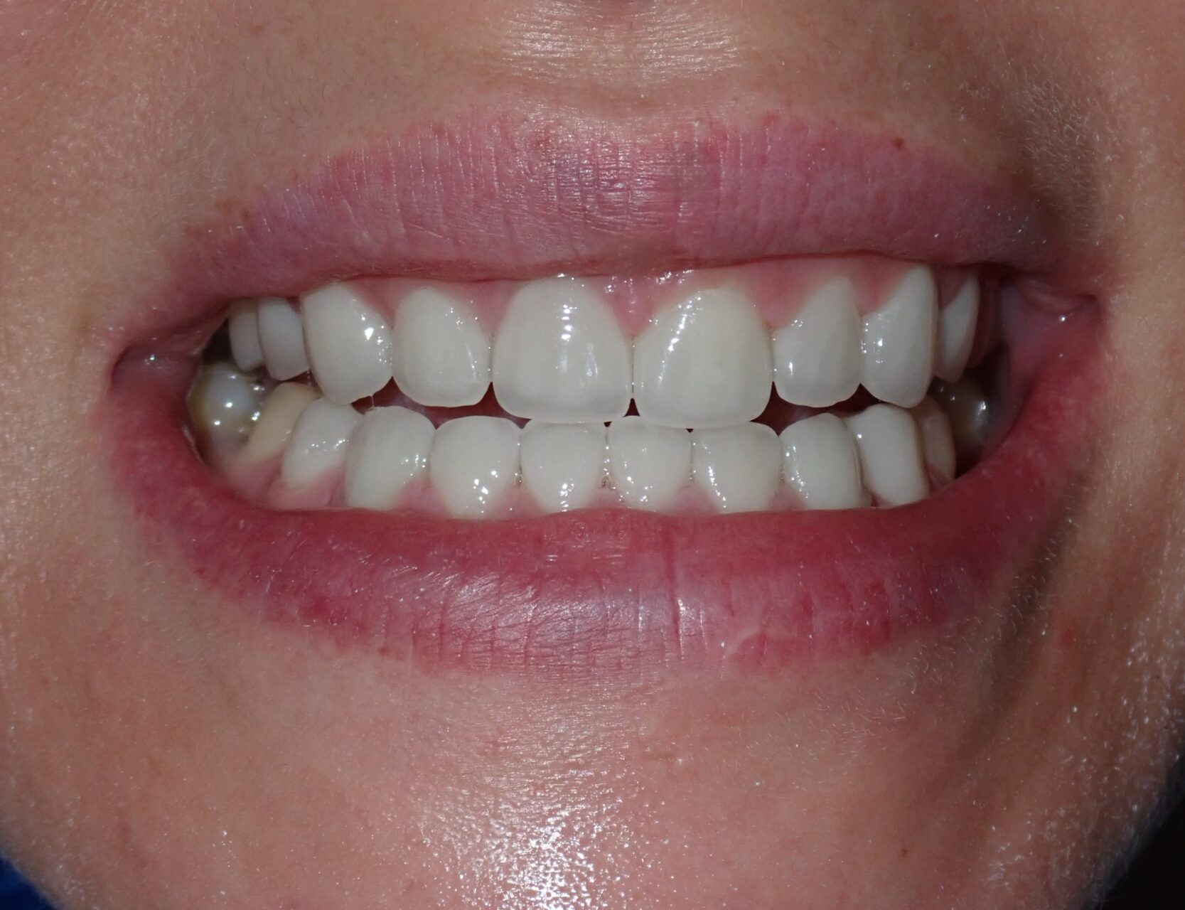 Case4-After