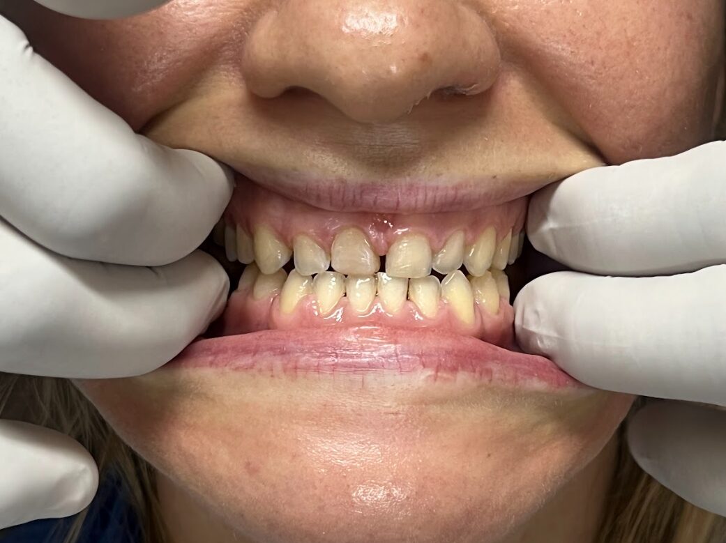 Case4 Before