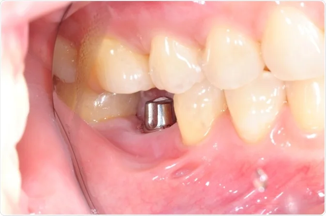 Cost Of Dental Implant
