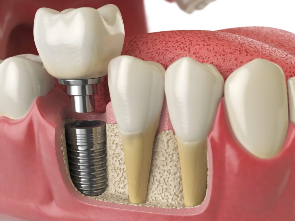Evolution Of Dental Implants In India