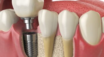 Evolution Of Dental Implants In India