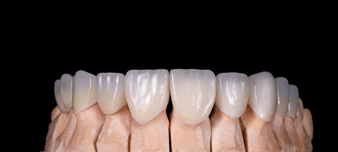 Ideal Candidates For All Ceramic Restorations