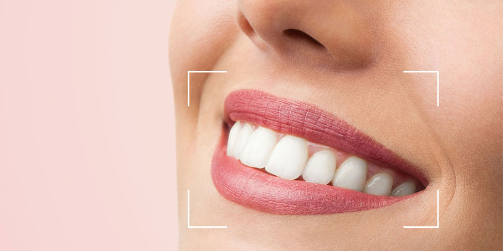 Smile Design