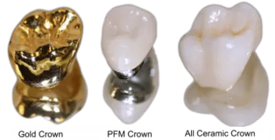 Why Choose All Ceramic