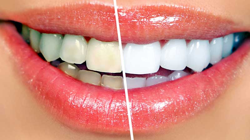 Why Whitening First